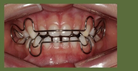 Imagem de tratamento odontológico